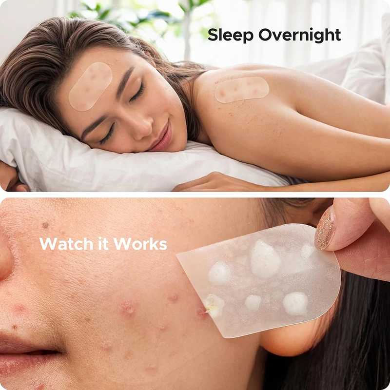 116 Stuks Anti-Acne Patches Vl - Beauty And Makeup Quotes recensie en prijs